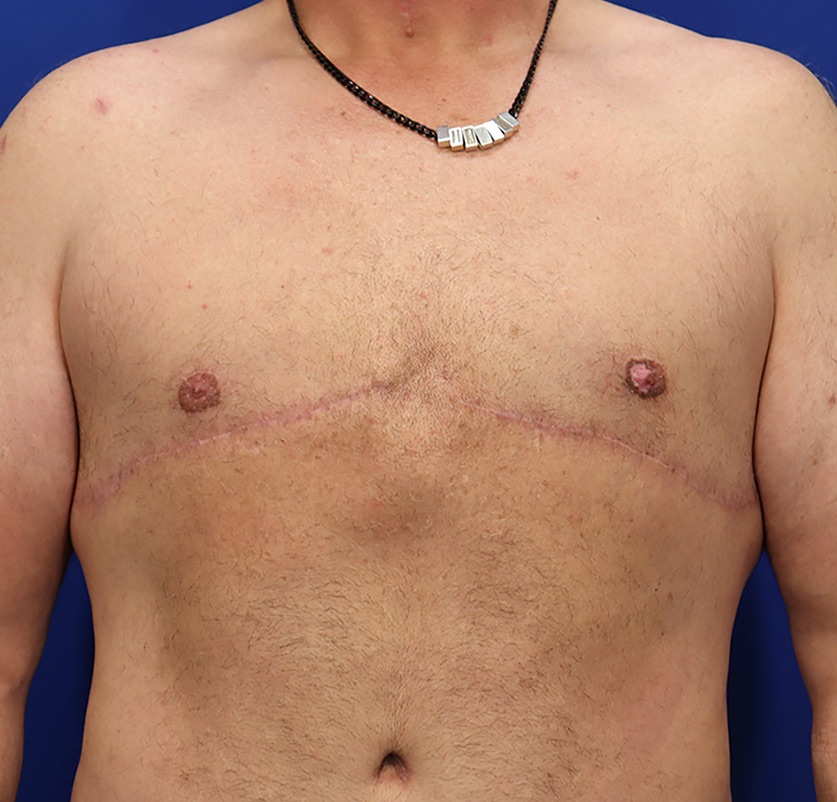 Gynecomastia Before & After Image