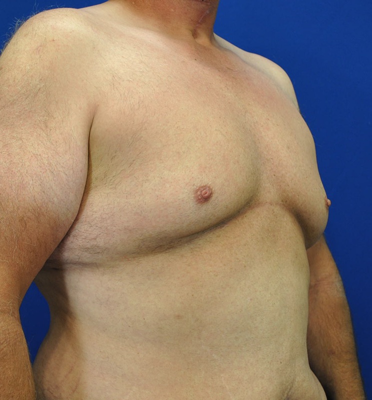 Gynecomastia Before & After Image