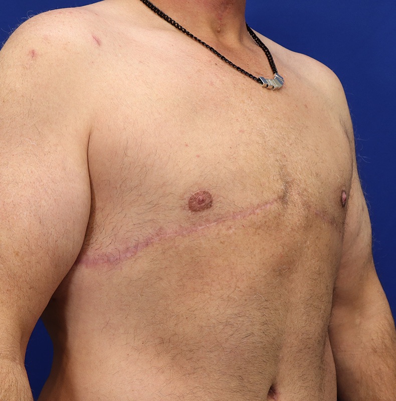 Gynecomastia Before & After Image