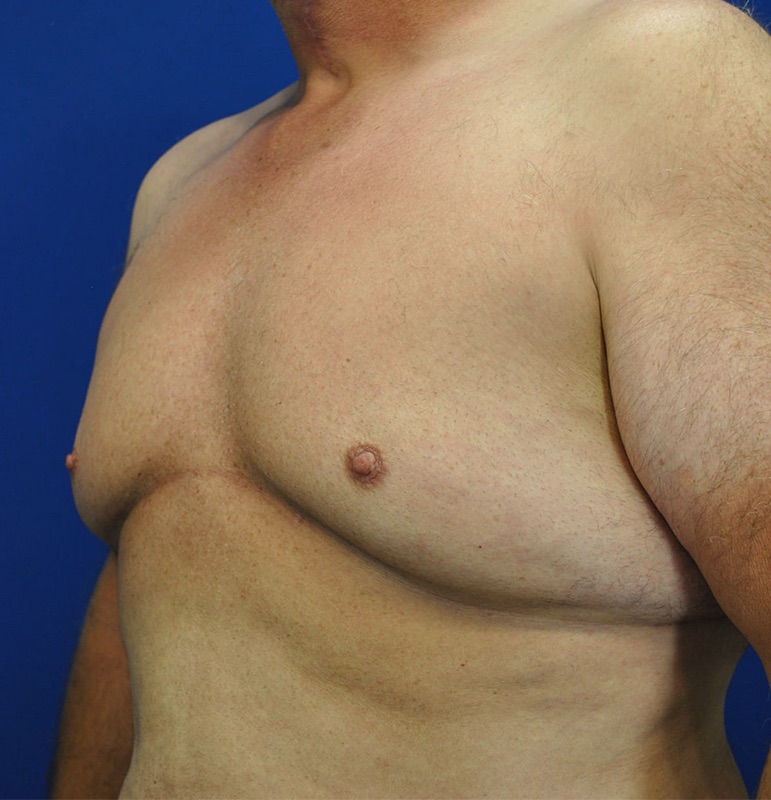 Gynecomastia Before & After Image