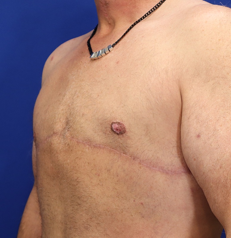 Gynecomastia Before & After Image